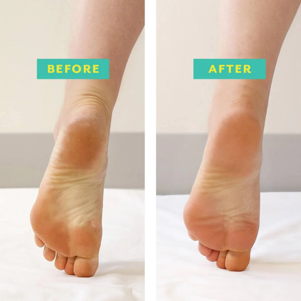 PoshPeel Pedi Cure – 1 Pair - Image 3