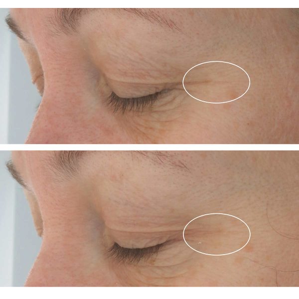 StriVectin Hyaluronic Tripeptide Gel-Cream for Eyes - 2-pack - Image 5